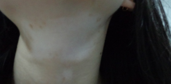 女性白癜风在护理上该做些什么