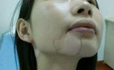 适合白癜风患者在换季时的皮肤补水方法