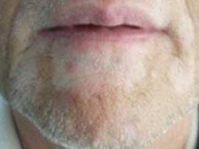 白癜风患者在秋季要怎么护理