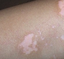 白癜风的预防措施具体包括哪些