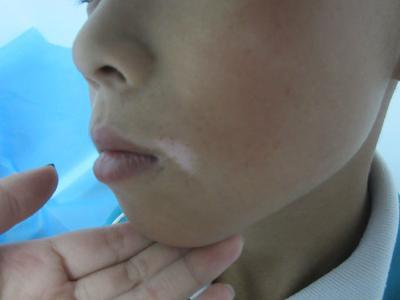 白癜风让他的童年蒙上阴影 谁来照亮他内心的阴暗