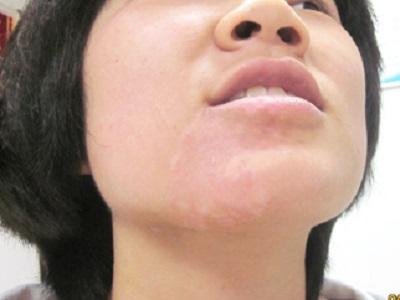 工作生活被白癜风扰的一团糟 年轻女孩奋起反抗